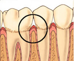 Perfect Smile periodontium with gengivitis